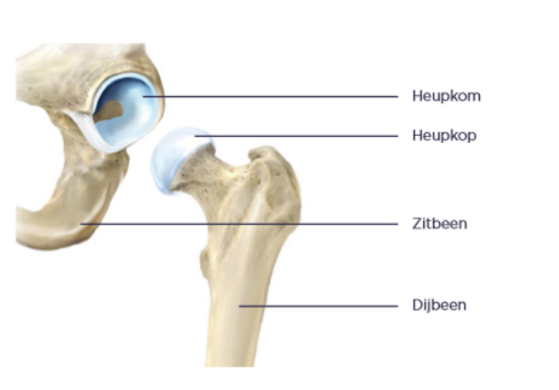 Heupslijtage Artrose En Prothesen